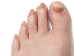 We Treat Fungal Infections